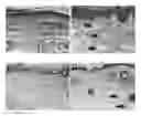 Fig. 01 - Method for the treatment of acquired lymphedema