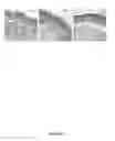 Fig. 12 - Method for the treatment of acquired lymphedema