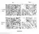 Fig. 32 - Method for the treatment of acquired lymphedema