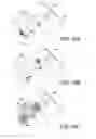 Fig. 06 - POST-BIOPSY CAVITY TREATMENT IMPLANTS AND METHODS