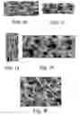 Fig. 12 - POST-BIOPSY CAVITY TREATMENT IMPLANTS AND METHODS