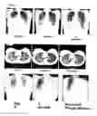 Fig. 04 - Methods and compositions for detecting a drug resistant EGFR mutant