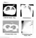 Fig. 05 - Methods and compositions for detecting a drug resistant EGFR mutant