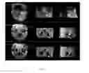 Fig. 06 - Multimodal imaging of fibrin