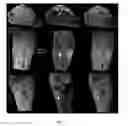 Fig. 08 - Multimodal imaging of fibrin