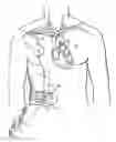 Fig. 01 - Methods, devices and systems for counterpulsation of blood flow to and from the circulatory system