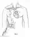Fig. 02 - Methods, devices and systems for counterpulsation of blood flow to and from the circulatory system