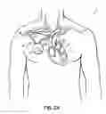 Fig. 03 - Methods, devices and systems for counterpulsation of blood flow to and from the circulatory system