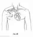 Fig. 04 - Methods, devices and systems for counterpulsation of blood flow to and from the circulatory system