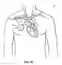 Fig. 05 - Methods, devices and systems for counterpulsation of blood flow to and from the circulatory system