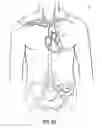 Fig. 06 - Methods, devices and systems for counterpulsation of blood flow to and from the circulatory system
