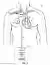 Fig. 07 - Methods, devices and systems for counterpulsation of blood flow to and from the circulatory system