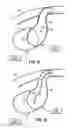 Fig. 11 - Methods, devices and systems for counterpulsation of blood flow to and from the circulatory system