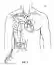 Fig. 12 - Methods, devices and systems for counterpulsation of blood flow to and from the circulatory system
