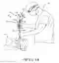 Fig. 03 - Endotracheal intubation device