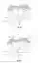Fig. 10 - Apparatus and method for intra-abdominally moving a first internal organ to a position away from a second internal organ and then holding the first internal organ in the position without manual input