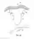 Fig. 21 - Apparatus and method for intra-abdominally moving a first internal organ to a position away from a second internal organ and then holding the first internal organ in the position without manual input