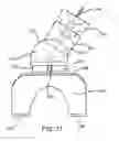 Fig. 14 - Method and Devices for Improved Tissue Stabilization