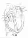 Fig. 11 - Heart wall ablation/mapping catheter and method