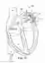 Fig. 12 - Heart wall ablation/mapping catheter and method