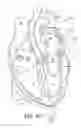 Fig. 13 - Heart wall ablation/mapping catheter and method