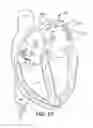 Fig. 17 - Heart wall ablation/mapping catheter and method