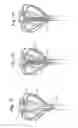 Fig. 12 - Cardiac mapping catheter