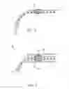 Fig. 03 - MEANS FOR SECURING A CATHETER INTO A VESSEL
