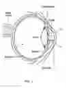 Fig. 02 - Method for increasing ocular depth of field
