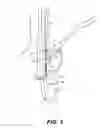 Fig. 04 - Endoluminal fundoplication device and related method