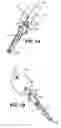Fig. 02 - Apparatuses and methods for forming incisions in ocular tissue