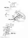Fig. 04 - Apparatuses and methods for forming incisions in ocular tissue
