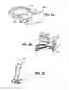 Fig. 05 - Apparatuses and methods for forming incisions in ocular tissue