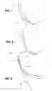 Fig. 05 - Endovascular filter and retrieval apparatus