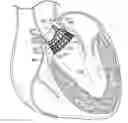 Fig. 01 - Prosthetic heart valve frame with flexible commissures