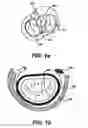 Fig. 02 - Devices and methods for heart valve treatment