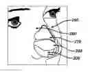 Fig. 01 - Columellar strut for nasal tip support