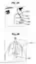 Fig. 06 - Columellar strut for nasal tip support