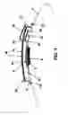 Fig. 02 - Systems and methods for on-aircraft composite repair using double vacuum debulking