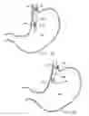 Fig. 08 - Remote tissue retraction device