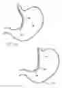 Fig. 47 - Remote tissue retraction device