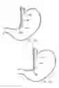 Fig. 48 - Remote tissue retraction device