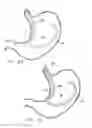 Fig. 52 - Remote tissue retraction device