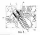 Fig. 05 - Intracranial neural interface system