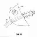 Fig. 22 - Methods and devices for treatment of migraines