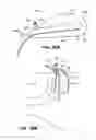 Fig. 32 - Methods and devices for treatment of migraines