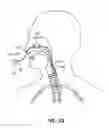 Fig. 37 - Methods and devices for treatment of migraines