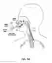 Fig. 40 - Methods and devices for treatment of migraines