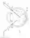 Fig. 04 - METHOD FOR REMOVAL OF RETAINED LENS FRAGMENTS USING SMALL DIAMETER FRAGMATOME