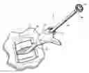 Fig. 01 - Surgical retrieval apparatus